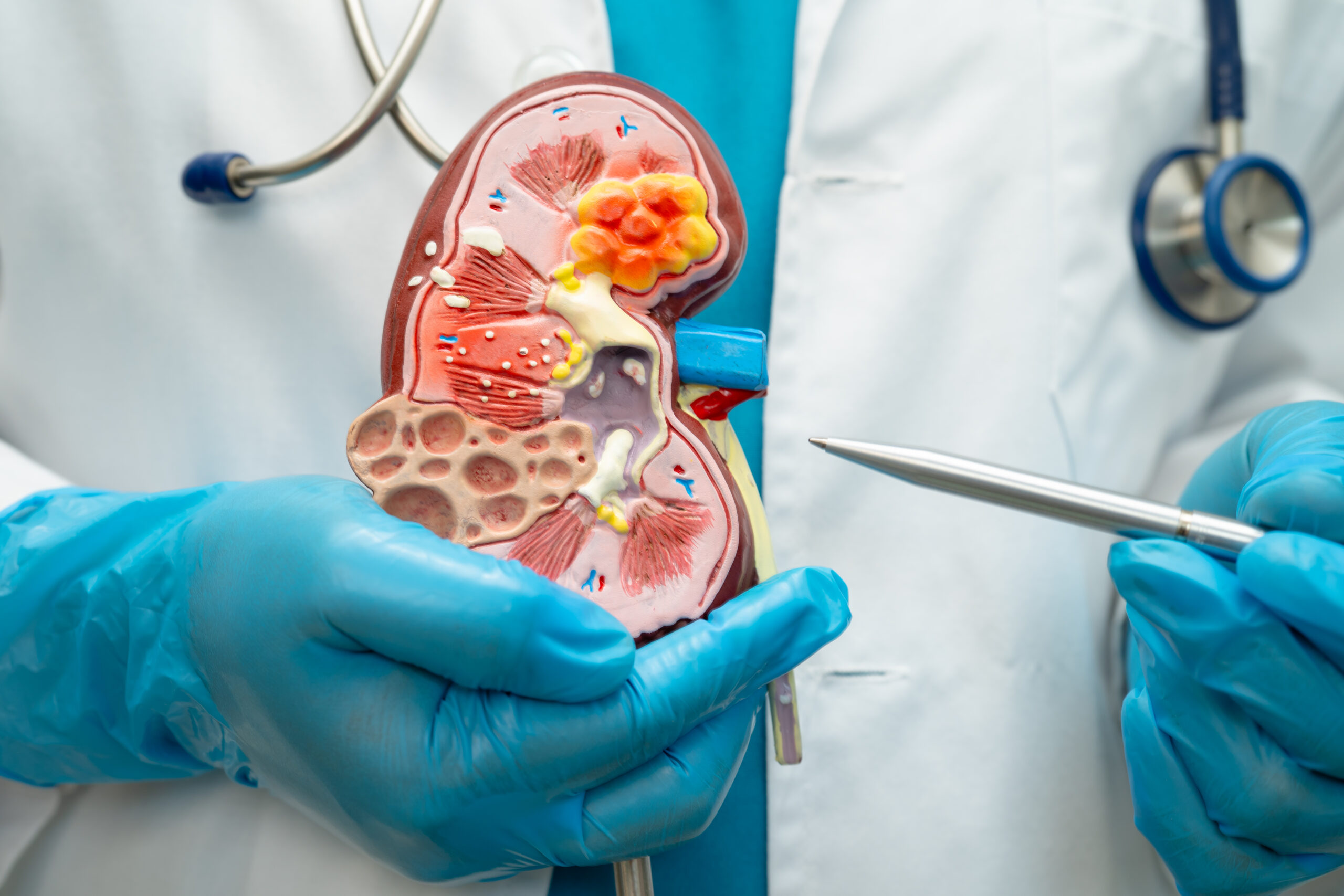 Early Signs of Kidney Stones You Should Never Ignore